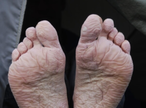 recognizing the symptoms of trench foot - if left untreated